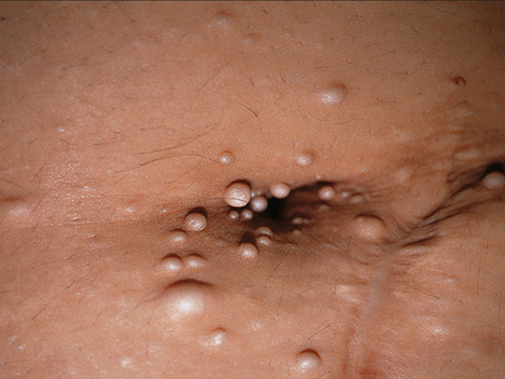 Multiple collagenomas