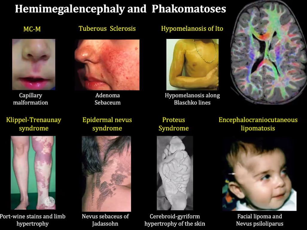 malformation Klippel-Trenaunay syndrome Port-wine stains and limb hypertrophy Sebaceum Epidermal nevus syndrome Nevus sebaceus of Jadassohn Blaschko lines Proteus Syndrome Cerebroid-gyriform hypertrophy of the skin Encephalocraniocutaneous lipomatosis Facial lipoma and Nevus psiloliparus 