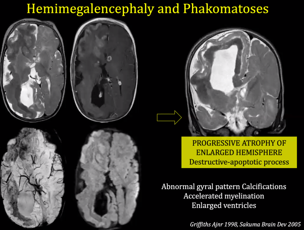 Hemimegalencephaly and Phakomatoses PROGRESSIVE ATROPHY OF ENLARGED HEMISPHERE Destructive-apoptotic process Abnormal gyral pattern Calcifications Accelerated myelination Enlarged ventricles Griffiths Ajnr 1998, Sakuma Brain Dev 2005 