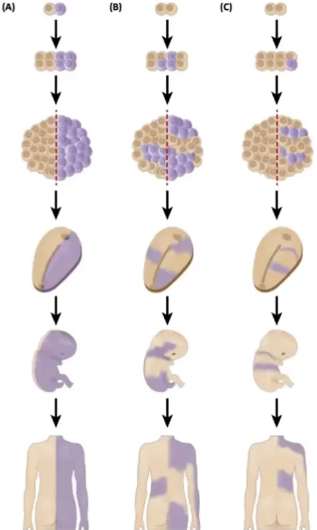 D GENETIC MOSAICS EXTENT AND SEVERITY s/ timing of the postzygotic mutation v/ amount of involved cells 
