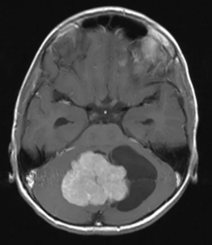 A close-up of a brain scan AI-generated content may be incorrect.