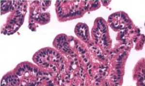 Fig. plen_ß A Well-diff—bated papillMY of a Engle of —phic B RegulM ff*niæd in 