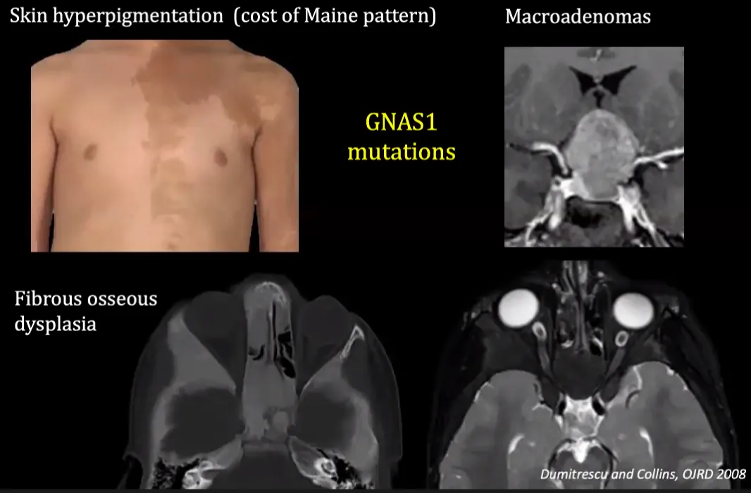 McCUNE-ALBRIGHT SYNDROME Skin hyperpigmentation (cost of Maine pattern) GNASI mutations Fibrous osseous dysplasia Macroadenomas itrescy and Collins, OJRD •2008 