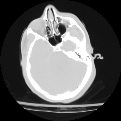 Figure 1: trace pneumo in transverse sinus in absence of skull fracture, most likely secondary to injection of contrast on pan-scans. 