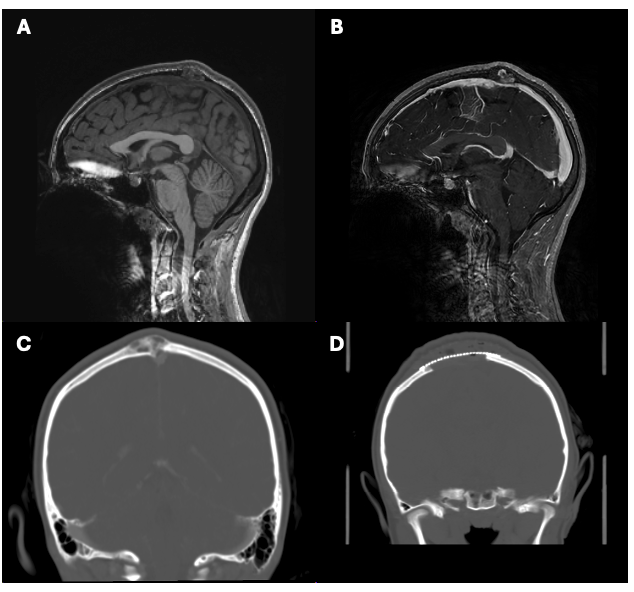 Figure 1: Growing Painless Vertex Fibrous Dysplasia in Healthy Adolescent with a right vertex fibrous dysplasia with minimal T1 hyperintensity (A) and diffuse hetergenous enhancement (B) with inner and outer table invasion and sagittal sinus abutment (C), underwent a bilateral parietal crani for gross total excision of lesion with 1cm margins circumferentially, and a titanium mesh cranioplasty (D). Final pathology demonstrated foci of bland-appearing fibroblasts admixed with irregular trabeculae of woven bone, areas of cystic change (pseudocyst appearance with no cyst lining), overall consistent with a diagnosis of FD. Intra-operatively, there was no soft tissue invasion. 