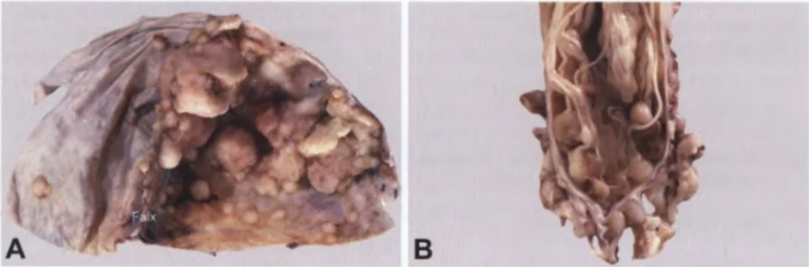 Fig. 8.02 Medulloblastoma_ A Sagittal section. The tumour occupies mostly the lower pan of the cerebellum. B Typical gross postmoltem appearance of a medulloblastoma in the cerebellar midline, occupying the cerebellar vermis_ C Diffuse CSF seeding by a medulloblastoma into the basal cistems and meninges_ Fig. 8.03 A Numerous medulloblastoma metastases of various sizes on the falx cerebri and the inner sufface of the dura mater covering the left cerebral hemisphere. Some smaller dural metastases are present on the contralateral side. B Multiple nodules in the cauda equina of the spinal cord representing CSF drop metastases of a medulloblastoma_ Fig. 8.04 infiltration by a cerebellar medulloblastoma of the subarachnoid space. Note the clusters of tumour cells in the molecular layer, particularly in the subpial regiom 