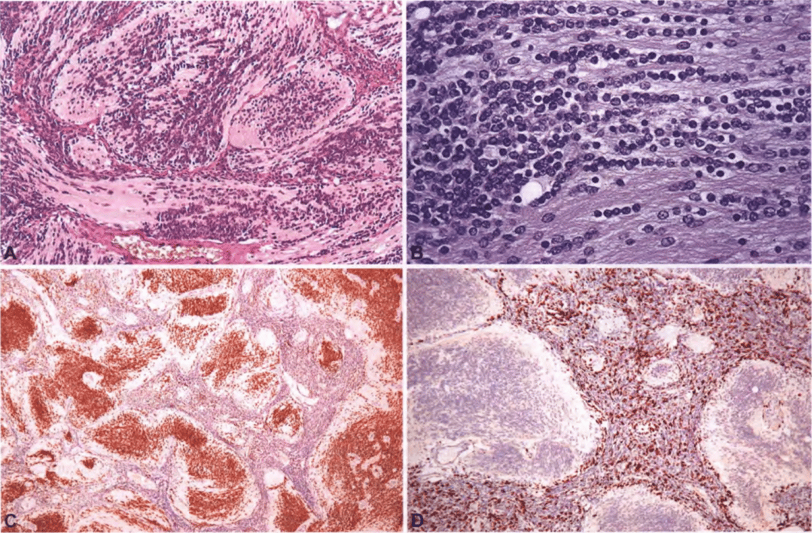 Medulloblastoma with extensive nodularity. (A) Lobular architecture with large, elongated, reticulin-free zones. (B) Elongated, reticulin-free zones containing streams of small round neurocytic cells on a fibrillary background. (C) Strong immunoreactivity for NeuN in neurocytic cells of pale islands. (D) High MIB1 immunolabelling in internodular regions, contrasting with minimal proliferation in pale islands.