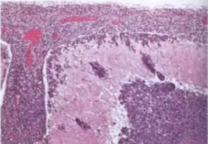 Fig. 8.02 Medulloblastoma_ A Sagittal section. The tumour occupies mostly the lower pan of the cerebellum. B Typical gross postmoltem appearance of a medulloblastoma in the cerebellar midline, occupying the cerebellar vermis_ C Diffuse CSF seeding by a medulloblastoma into the basal cistems and meninges_ Fig. 8.03 A Numerous medulloblastoma metastases of various sizes on the falx cerebri and the inner sufface of the dura mater covering the left cerebral hemisphere. Some smaller dural metastases are present on the contralateral side. B Multiple nodules in the cauda equina of the spinal cord representing CSF drop metastases of a medulloblastoma_ Fig. 8.04 infiltration by a cerebellar medulloblastoma of the subarachnoid space. Note the clusters of tumour cells in the molecular layer, particularly in the subpial regiom 
