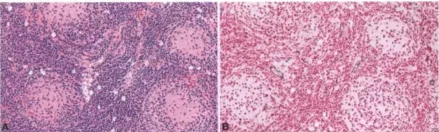 Fig. 8.11 Histopathological features of the classic medulloblastoma_ A Typical syncytial arrangement of undifferentiated tumour cells. B Area with Homer Wright (neuroblastic) rosettes. C Arranaement of tumour cells in parallel rows (soonaioblastic Dattern)_ Fig. 8.12 Medulloblastoma_ A Focal expression of synaptophysin_ B Focal GFAP staining oftumour cells. C Clusters of medulloblastoma cells expressing retinal S-antigen_ Fig. 8.13 A Classic medulloblastoma with nodules but (B) no desmoplasia_ Retculin staim These medulloblastomas belong to the non-WNT/non-SHH molecular group and should not be confused for desmoplastic/nodularmedulloblastomas. 