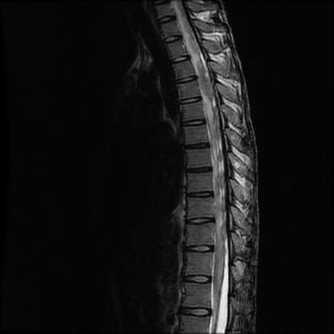 A close-up of an x-ray of a spine AI-generated content may be incorrect.