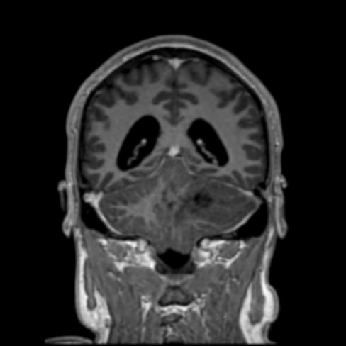 A close-up of a brain scan AI-generated content may be incorrect.