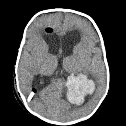 A brain scan with a needle in the middle AI-generated content may be incorrect.