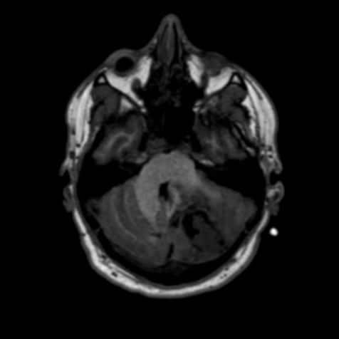 A close-up of a mri scan AI-generated content may be incorrect.