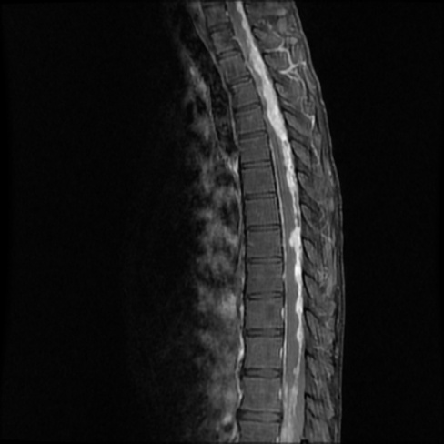 A close-up of an x-ray of a spine AI-generated content may be incorrect.