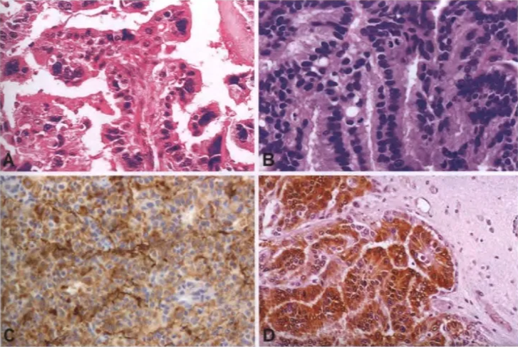 Fig. 5.10 Choroid plexus carcinoma. A Pleomorphism. B High mitotic activity. C Solid growth, high cellular density, and focal membranous staining for KIR7.1. D Infiltration of neighbouring brain tissue. Immunochemistry for transthyretin 