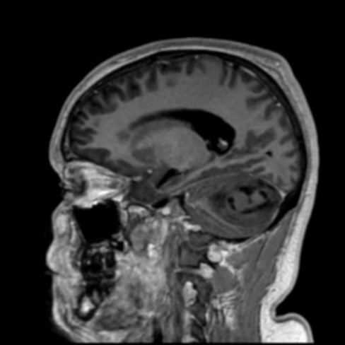 A close-up of a brain scan AI-generated content may be incorrect.