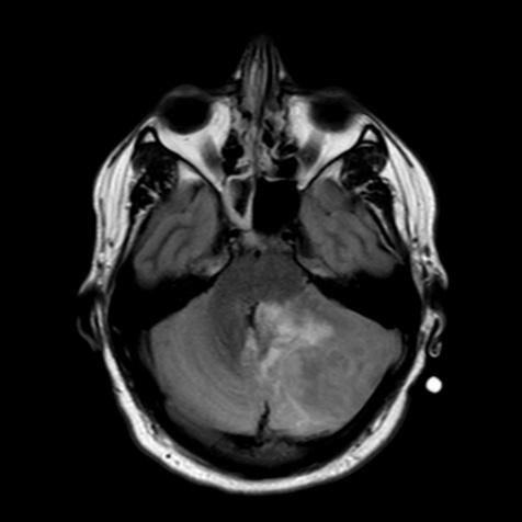 A mri of a brain AI-generated content may be incorrect.