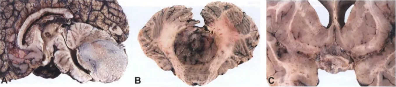 Fig. 8.02 Medulloblastoma_ A Sagittal section. The tumour occupies mostly the lower pan of the cerebellum. B Typical gross postmoltem appearance of a medulloblastoma in the cerebellar midline, occupying the cerebellar vermis_ C Diffuse CSF seeding by a medulloblastoma into the basal cistems and meninges_ Fig. 8.03 A Numerous medulloblastoma metastases of various sizes on the falx cerebri and the inner sufface of the dura mater covering the left cerebral hemisphere. Some smaller dural metastases are present on the contralateral side. B Multiple nodules in the cauda equina of the spinal cord representing CSF drop metastases of a medulloblastoma_ Fig. 8.04 infiltration by a cerebellar medulloblastoma of the subarachnoid space. Note the clusters of tumour cells in the molecular layer, particularly in the subpial regiom 