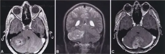 Machine generated alternative text: Fig. 8.16 Desmoplastic/nodular medulloblastoma_ A T I-weighted. (B) T2-weighted contrast-enhanced MRI of tumours in the cerebellar hemisphere. C Tl-weighted, contrast- enhanced MRI of a tumour in the vermis_ 