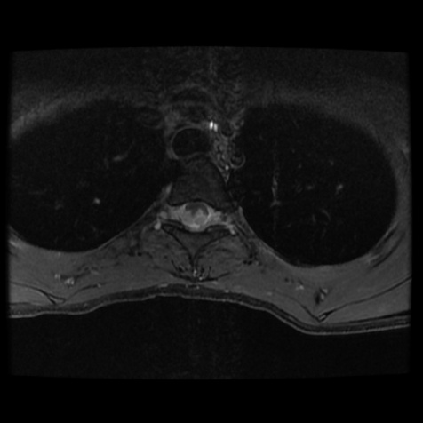 A close-up of a chest x-ray AI-generated content may be incorrect.
