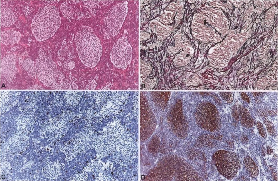 Fig. 8.17 Desmoplastic/nodular medulloblastoma_ A Pale nodular areas surrounded by densely packed hyperchromatic cells. B Reticulin silver impregnation showing the reticulin free pale islands. C MIBI monoclonal antibody staining shows that the proliferative activity predominates in the highly cellular, intermodal areas. D Neuronal differentiation, shown by immunoreactivity for neuron-specific enolase, occurs mainly in the pale islands. 