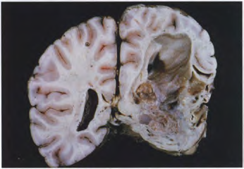 A close-up of a brain AI-generated content may be incorrect.