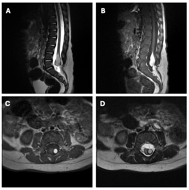 Figure 1: Term infant with gross motor delay and a lumbar hemangioma found to have a conus ending at L3-4 with a large lipoomyelomeningocele. Laminectomies at L3 and partially at L2 were performed to identify the lipoomatous mass, which was resected with sonopet after ruling out neural tissue with stimulation at 0.4-1.0 mA. Subsequently, circumferential dissection was undertaken to identify superior and inferior margins of lipoma safely. Intraoperatively, two points of fatty tethering to spinal cord were identified.    