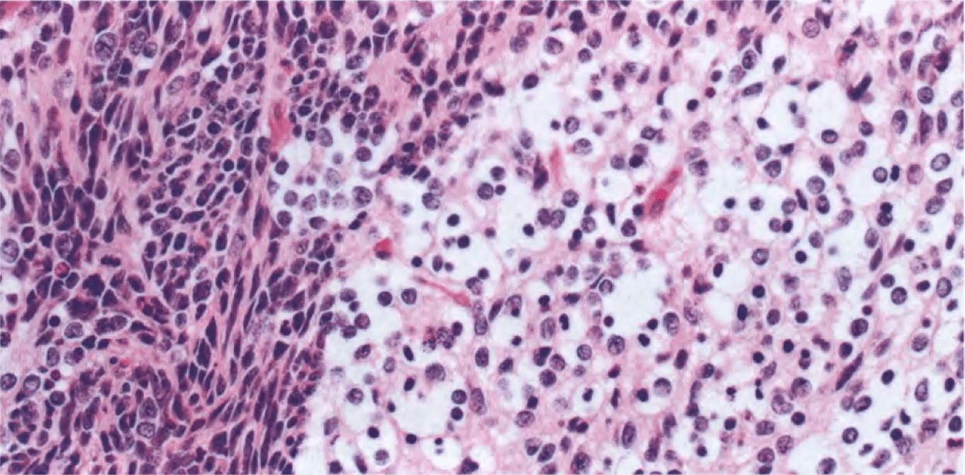 CNS neuroblastoma. Abrupt transition from undifferentiated embryonal cells to cells with variable neurocytic differentiation and cytoplasmic clearing. 