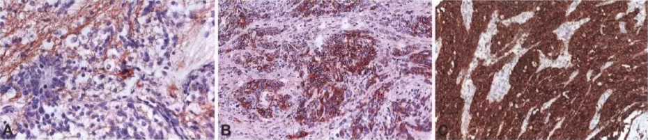 Fig. 8.26 ETMR, with mophology of ernbyonal tumour w•lth abundant neuropil and bue rosett—. A Neoplastlc neurons bäween aggregates of •mall cells. B Rosettes in neuropil- like areas. C Single cells and clusters of LIN28.A-posittve tumour cells. Fig. 8.27 ETMR, with morphology of embryona' tumour with abundant neuropll and true rosettes. A Synaptophysin expression within neuropll areas. a Vimentin expression. C Intense LIN28A immunoreacttvity. 
