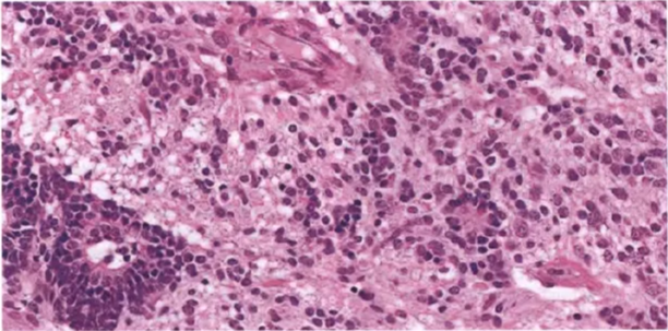 Fig. 8.24 Embryonal tumour with abundant neurcOI and bue rosetes. 31*asIc pattem: areas of small embryonal cells with multilayered rosettes and neuropil-like areas With neopLastic neurocytc cells. Fig. 8.26 Multilayered rosette: a key diagnosbc feature of embryonal tumours with multilayered rosettes. 