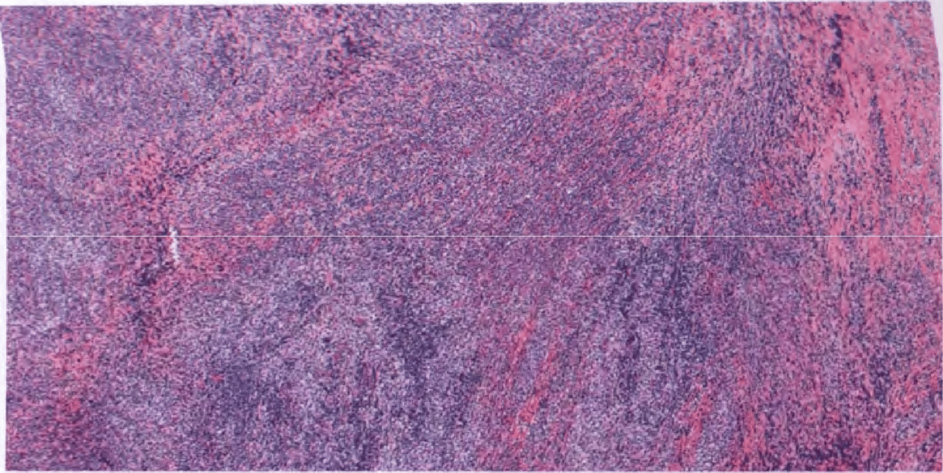 MALT lymphoma of the dura. Vaguely nodular and diffuse proliferation of lymphoid cells in the frontal dura.