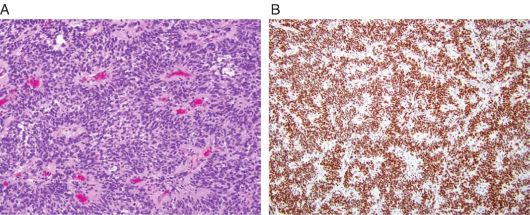 Fig. 5 CNS tumor with BCORinternaltandem duplication is a neoplasm with a mostly solid growth pattern, uniform oval or spindle-shaped cells, a dense capillary network, focal pseudorosette formation, and an internal tandem duplication (ITD) in exon 15 of the BCOR gene. (A) High-grade neo- plasm with perivascular rosettes (H&E, and (B) strong, diffuse nuclear staining on BCOR immunohistochemistry (x100). 