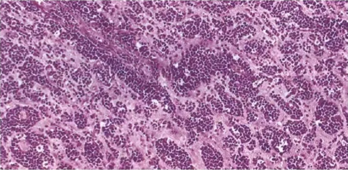 Fig. 13.04 Perivascular accumulation of lymphoma cel embedded in a concentric network of reticulin fibres. I. with characteristic perivascular spread of tumour cells. 