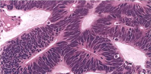 ETMR, medulloepithelioma morphology. Papillary-like and tubular structures resembling the primitive neural tube.