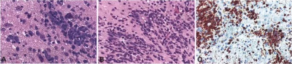 Fig. 8.26 ETMR, with mophology of ernbyonal tumour w•lth abundant neuropil and bue rosett—. A Neoplastlc neurons bäween aggregates of •mall cells. B Rosettes in neuropil- like areas. C Single cells and clusters of LIN28.A-posittve tumour cells. Fig. 8.27 ETMR, with morphology of embryona' tumour with abundant neuropll and true rosettes. A Synaptophysin expression within neuropll areas. a Vimentin expression. C Intense LIN28A immunoreacttvity. 