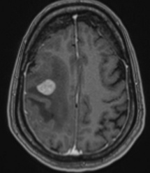 A close-up of a brain scan AI-generated content may be incorrect.