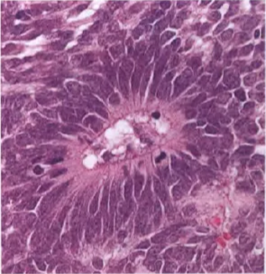 Fig. 8.24 Embryonal tumour with abundant neurcOI and bue rosetes. 31*asIc pattem: areas of small embryonal cells with multilayered rosettes and neuropil-like areas With neopLastic neurocytc cells. Fig. 8.26 Multilayered rosette: a key diagnosbc feature of embryonal tumours with multilayered rosettes. 