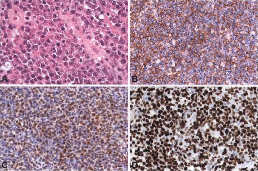 Fig. 13.05 Primary CNS lymphoma. A Diffuse large B-cell lymphoma. B Tumour cells the pan-B-cell marker )D20. C Expression of the BCL6 protein by the turnour cells. D strong nuclear expression oftheMjMl protein by the 