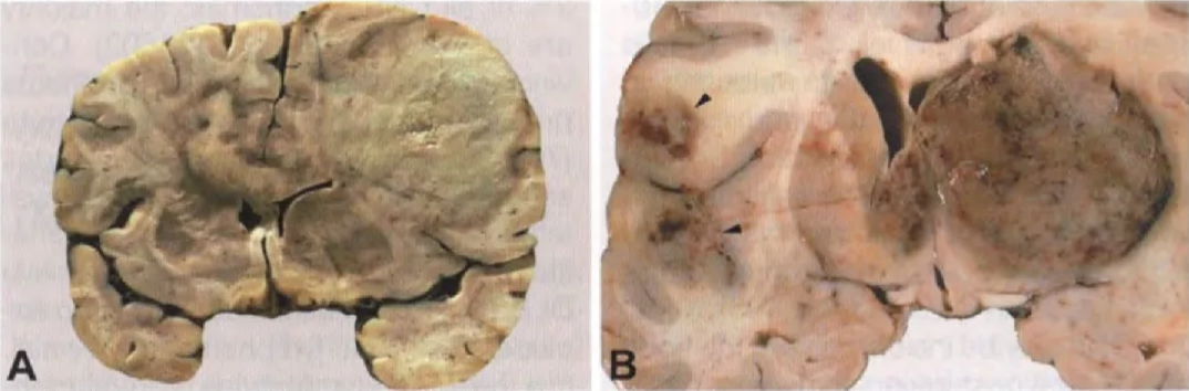 Fig. 13.08 A Large, necrotizing diffuse large B-cell lymphoma of the right hemisphere, extending via the corpus callosum into the white matter of the left hemisphere. The patient was an HIV-I-infected infant. B Primary malignant CNS lymphomas of the basal ganglia. Note the additional foci in the left insular region (arrowheads). 