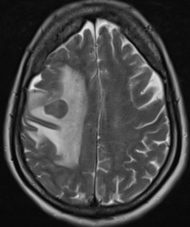 A close-up of a brain scan AI-generated content may be incorrect.