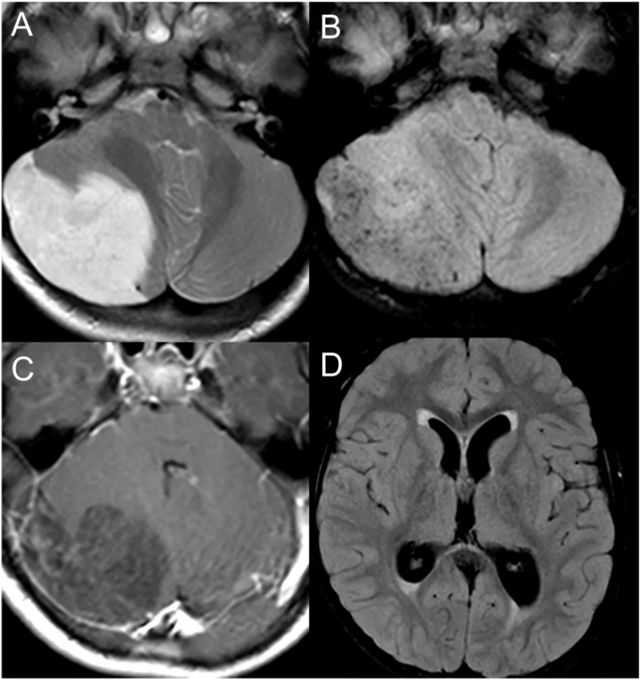 A close-up of a brain scan AI-generated content may be incorrect.