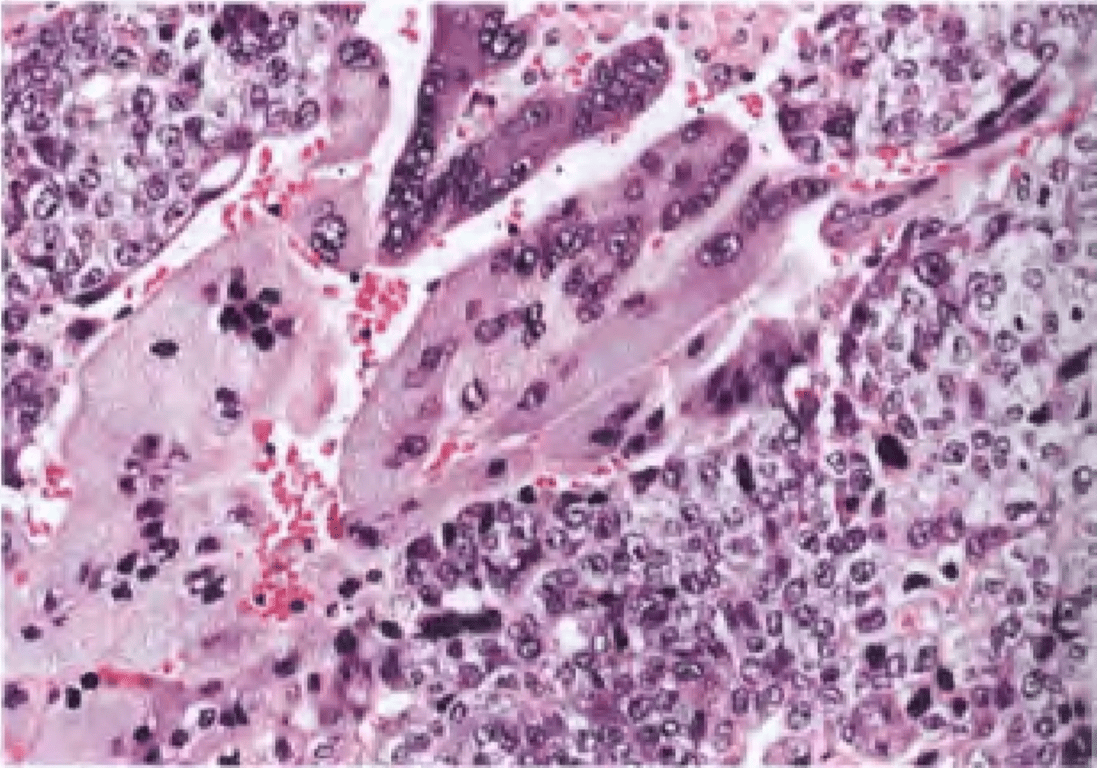 Choriocarcinoma with syncytiotrophoblastic giant cells and cytotrophoblasts.
