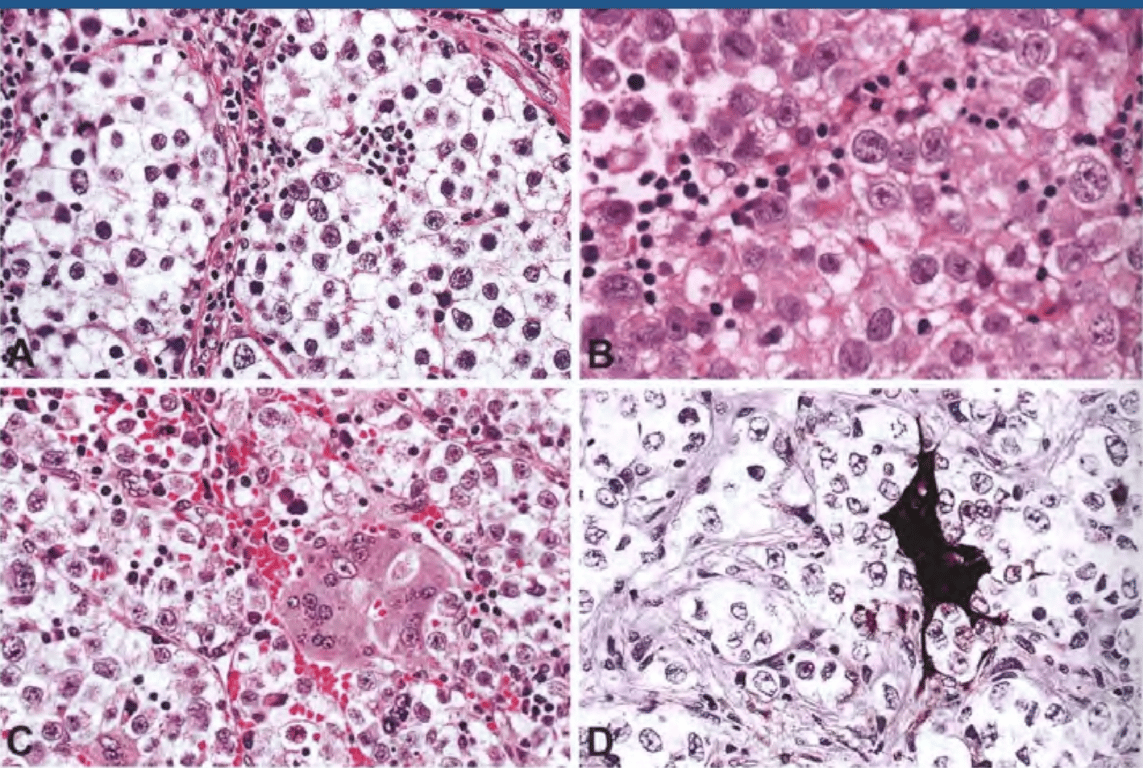Germinoma. 
(A) Tumour cells with abundant clear cytoplasm, round nuclei, and prominent nucleoli; note the lymphocytic infiltrates along fibrovascular septa. 
(B) Large tumour cells with round vesicular nuclei, prominent nucleoli, and clear cytoplasm. 
(C) Syncytiotrophoblastic giant cell in an otherwise typical germinoma. 
(D) Immunostaining for hCG.