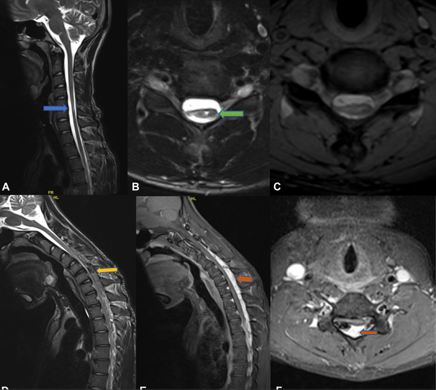 Magnetic resonance imaging of the spine of a patient with Hirayama disease. (A) Sagittal T2-weighted image showing atrophy of the cervical cord most pronounced at the C5-6 interval (blue arrow). (B) Axial T2-weighted section of the cord at this level showing a T2 hyperintense signal in the anterior horn cell location, with asymmetric (right >left) atrophy and a pyriform morphology to the cord (green arrow). (C) Absence of intramedullary blooming is seen in the gradient recalled echo imaging. (D) Sagittal T2-weighted imaging with flexion showing prominent posterior epidural flow void and engorgement consequent to the loss of dural attachment (yellow arrow). (E, F) Dynamic postcontrast T1-weighted imaging with flexion showing intense postcontrast posterior epidural enhancement (orange arrows).