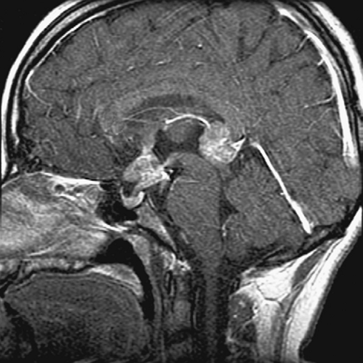 Bifocal (synchronous) germinoma