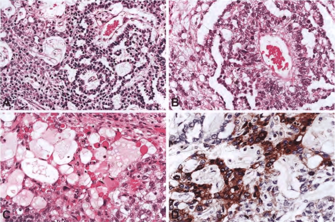 Yolk sac tumour. 
(A) Typical sinusoidal growth pattern. 
(B) Schiller–Duval body and numerous mitoses. 
(C) Reticular growth pattern with numerous hyaline globules. 
(D) Alpha-fetoprotein immunolabelling.