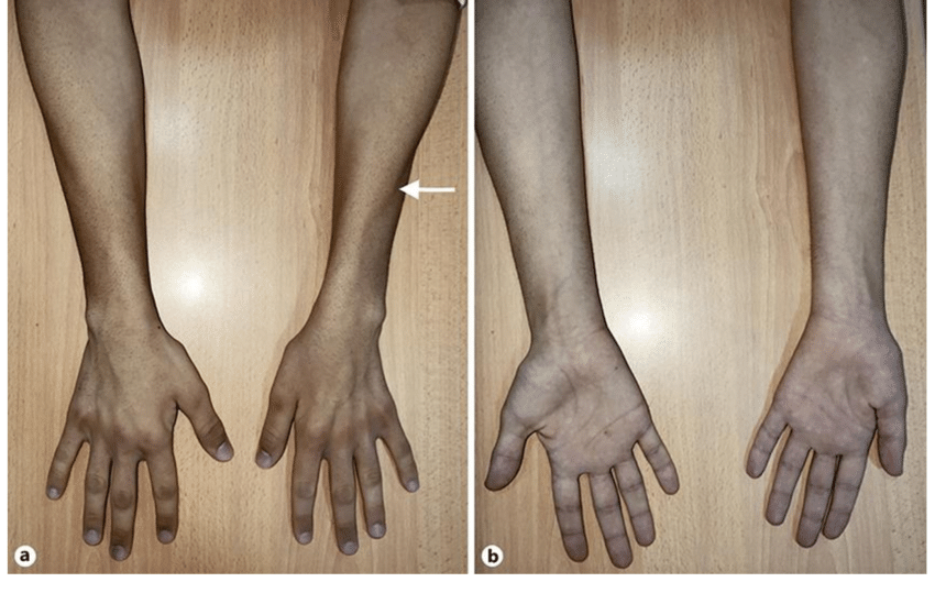 Reverse split hand syndrome in HA