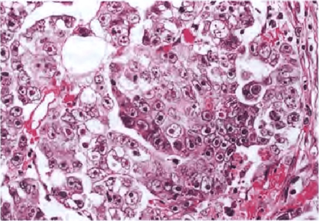 Embryonal carcinoma composed of large epithelial cells forming abortive papillae and glandular structures with macronuclei.