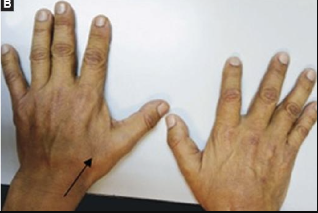 Split hand syndrome in ALS 