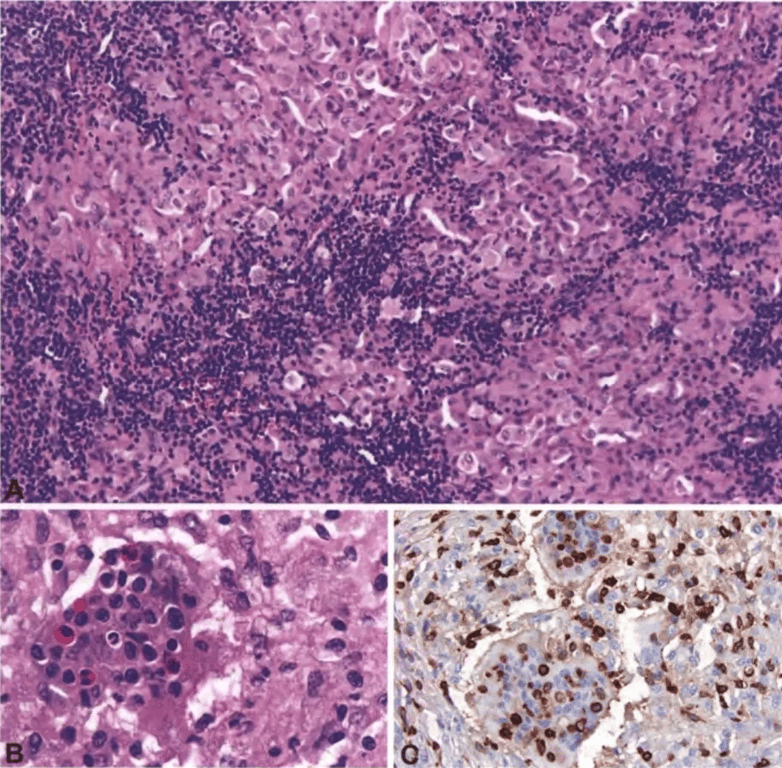 Fig. 14.04 Rosai-Dorfman disease. A Multinodular mass composed of a mixed inflammatory infiltrate, including large pale histiocytes, numerous lymphocytes, and plasma cells. B Emperipolesis with histiocytic engulfment of intact lymphocytes, plasma cells, neutrophils, and eosinophils. C CD45 expression by phagocytosed haematopoietic cells. 